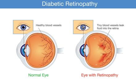 15 Facts About Diabetic Retinopathy