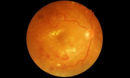 What is Diabetic Retinopathy?